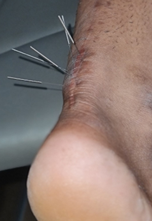 Dry Needling